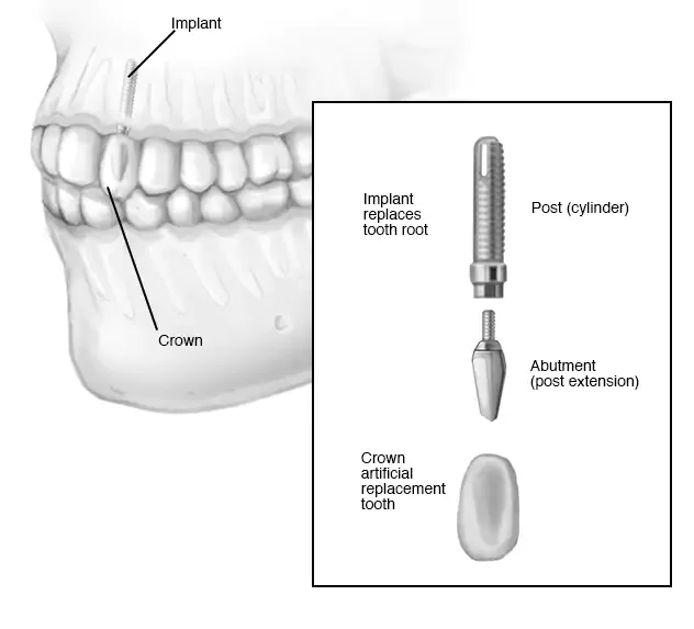 implant