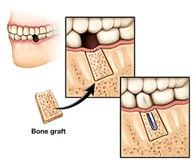 Jawbone graft