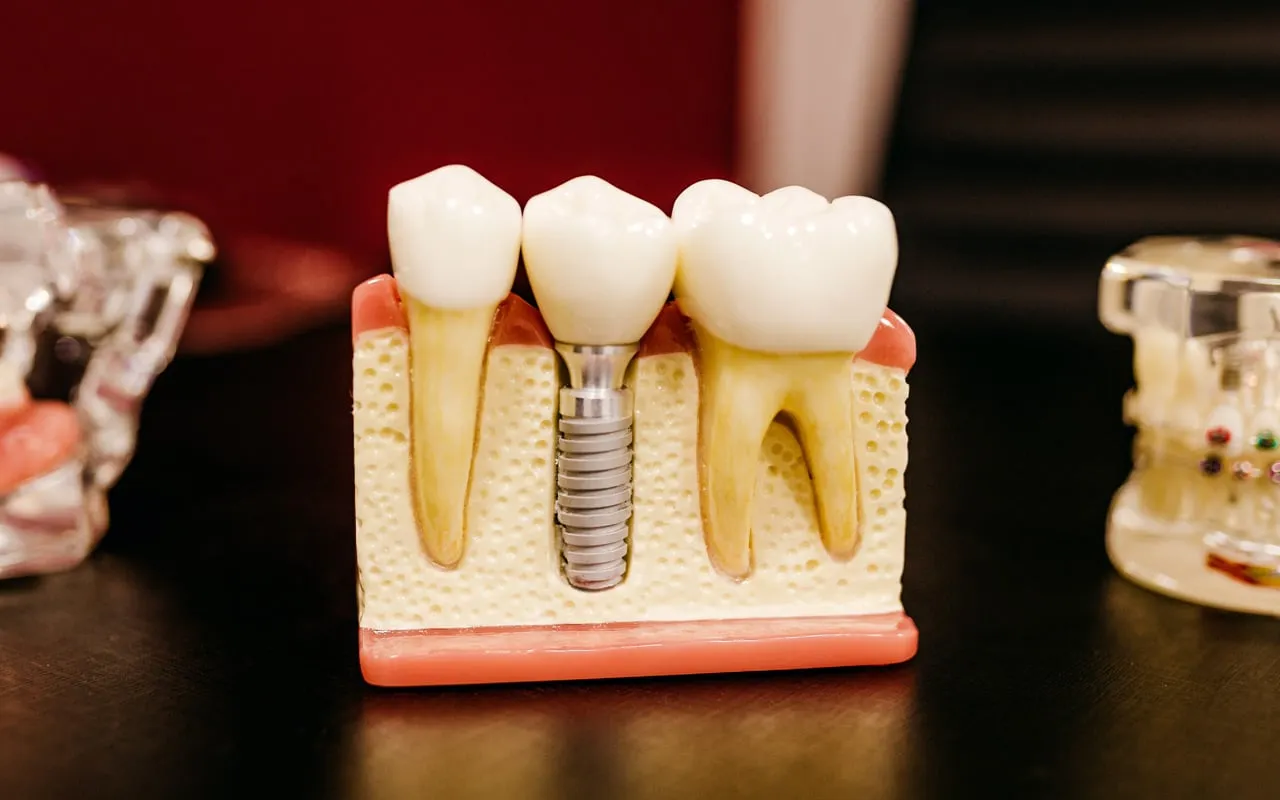 Dental implant surgery