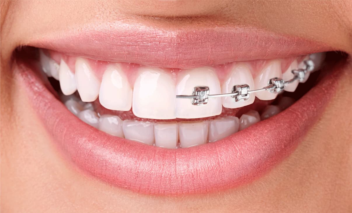 Ceramic Braces vs. Metal Braces