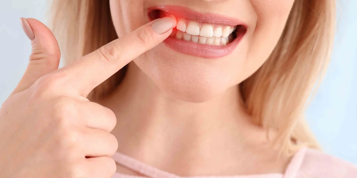 آشنایی با مراحل بیماری لثه