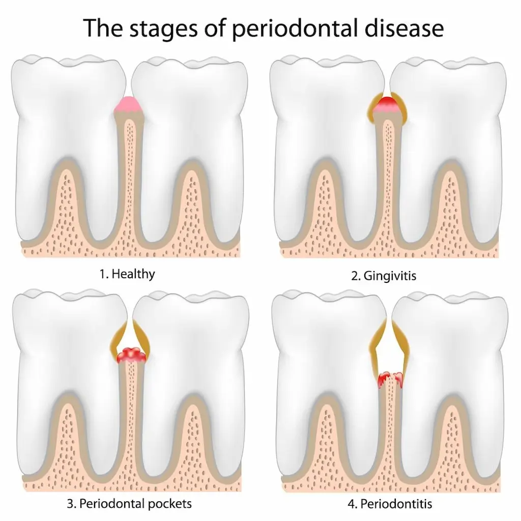 gum-disease