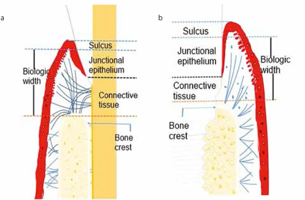 peri-implantitis-1