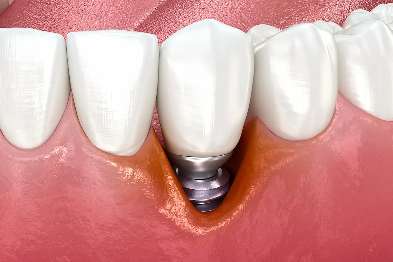 Biological Importance of Soft Tissue Management in Implant Surgery; A Key Strategy for Preventing Peri-implantitis
